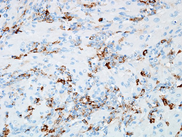 1I3 Granular Cell Tumor (Case 1) EMA 1