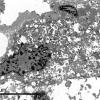 1J7 Granular Cell Tumor (Case 1) EM 4 - Copy