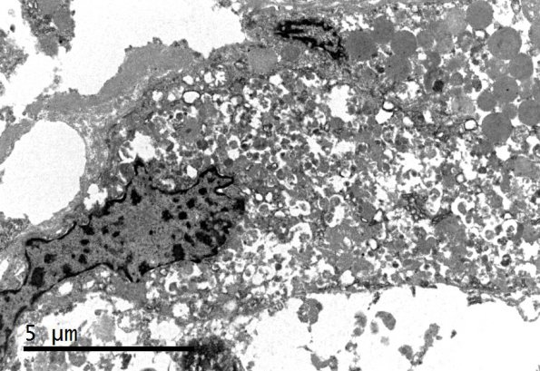 1J7 Granular Cell Tumor (Case 1) EM 4 - Copy