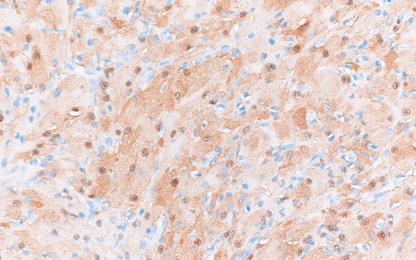 2B3 Granular Cell Tumor, Sella Region (Case 2) S100 40X 4