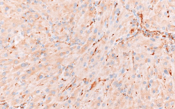 2C3 Granular Cell Tumor, Sella Region (Case 2) CD68 40X 1