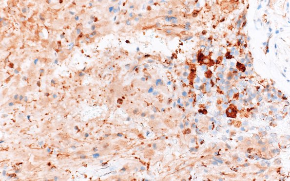 2C4 Granular Cell Tumor, Sella Region (Case 2) CD68 40X 2