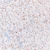 2E1 Granular Cell Tumor, Sella Region (Case 2) TTF1 20X