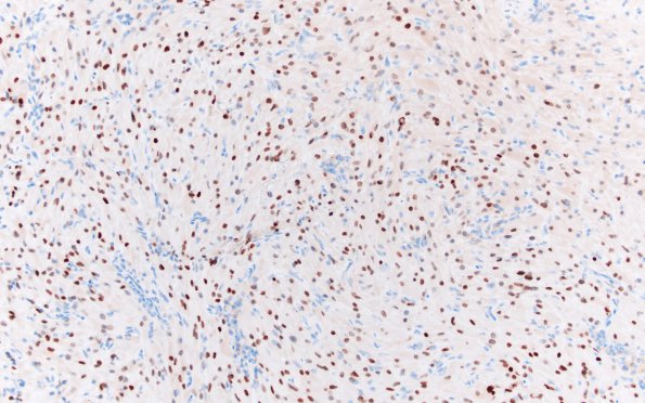 2E1 Granular Cell Tumor, Sella Region (Case 2) TTF1 20X