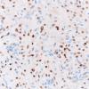 2E2 Granular Cell Tumor, Sella Region (Case 2) TTF1 40X