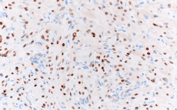 2E2 Granular Cell Tumor, Sella Region (Case 2) TTF1 40X