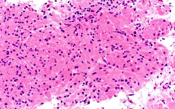 3A1 Granular cell tumor, infundibulum (Case 3) H&E 1