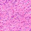 3A2 Granular cell tumor, infundibulum (Case 3) H&E 3