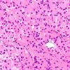 3A3 Granular cell tumor, infundibulum (Case 3) H&E 6