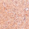 3B1 Granular cell tumor, infundibulum (Case 3) CD68 1