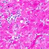 3C1 Granular cell tumor, infundibulum (Case 3) PAS 1