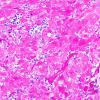 3C2 Granular cell tumor, infundibulum (Case 3) PAS with diastase 2