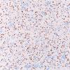 3E1 Granular cell tumor, infundibulum (Case 3) TTF-1 2