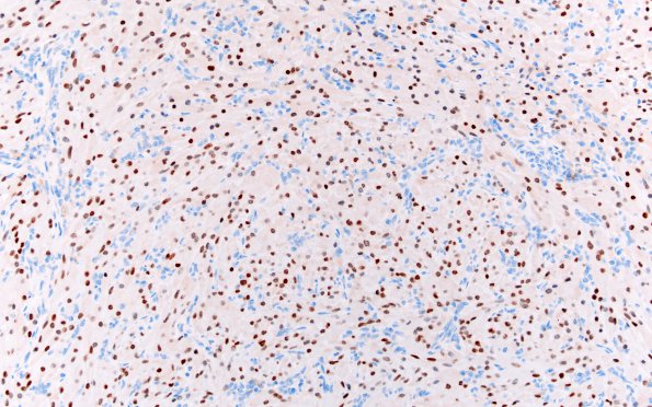 3E1 Granular cell tumor, infundibulum (Case 3) TTF-1 2