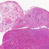 TTF-1-positive sellar tumor - Granular cell Tumor