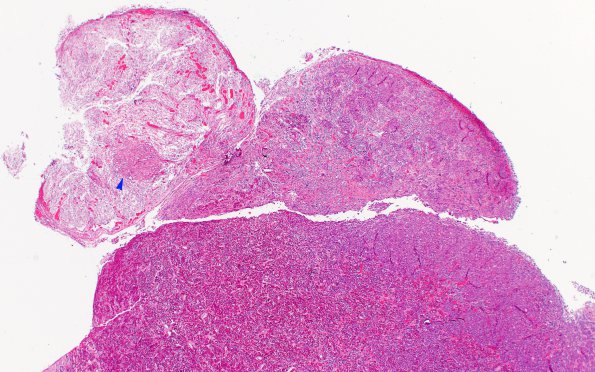 4A1 Granule Cell Tumor (Case 4) H&E 2X 2 copy