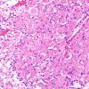 4A2 Granule Cell Tumor (Case 4) H&E 20X