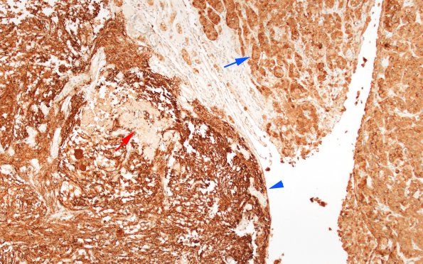 4B1 Granule Cell Tumor (Case 4) SYN 10X 1 copy