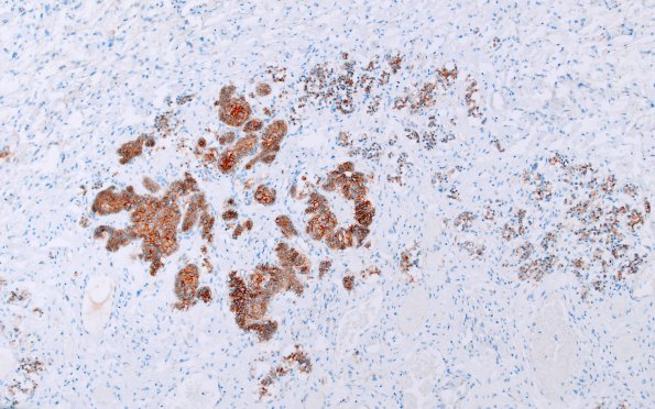 4C1 Granule Cell Tumor (Case 4) B-catenin 1