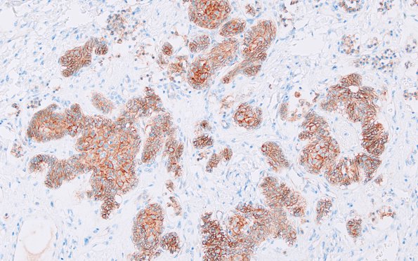 4C2 Granule Cell Tumor (Case 4) B-catenin 2