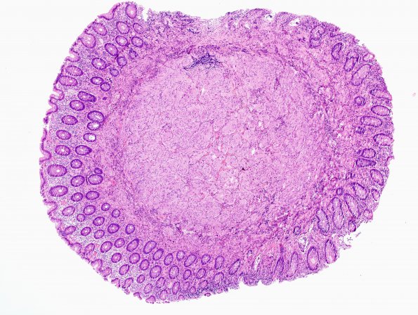 5A1 Granular Cell Tumor, colon polyp (Case 5) 1 H&E 4X 1