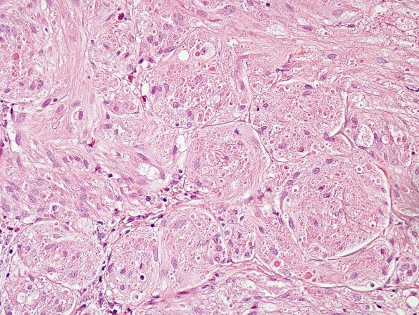 5A3 Granular Cell Tumor, colon polyp (Case 5) H&E 3