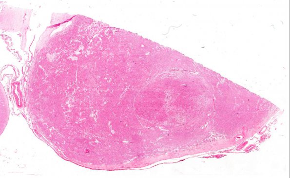 6A1 Granular cell tumor, suprasellar (AANP 1983, Case 8) H&E X0.5