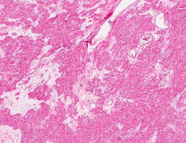 6A2 Granular cell tumor, suprasellar (AANP 1983, Case 8) H&E X5 1