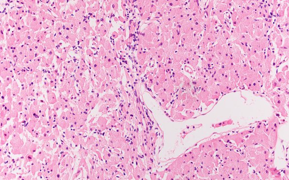 7A1 Granular cell tumor (Case 7) H&E 20X