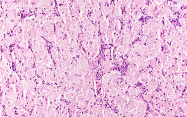 7A3 Granular cell tumor (Case 7) H&E  2nd slide 20X 2