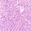 7A4 Granular cell tumor (Case 7) H&E  2nd slide 20X 3