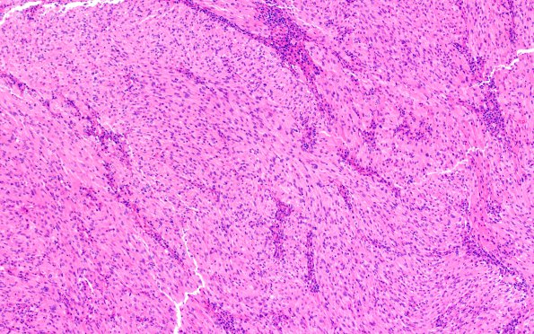 8B1 TTF1 Granular Cell Tumor (Case 8) H&E 10X