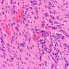 8B4 TTF1 Granular Cell Tumor (Case 8) H&E 40X 4