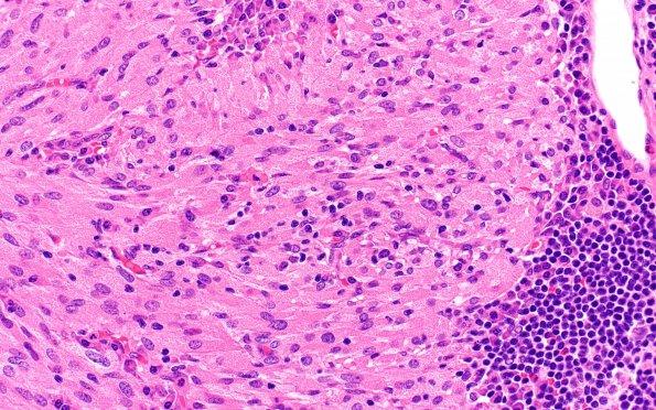 8B5 TTF1 Granular Cell Tumor (Case 8) H&E 40X