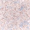 8C1 TTF1 Granular Cell Tumor (Case 8) TTF1 20X