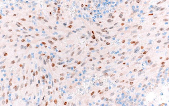 8C2 TTF1 Granular Cell Tumor (Case 8) TTF1 40X