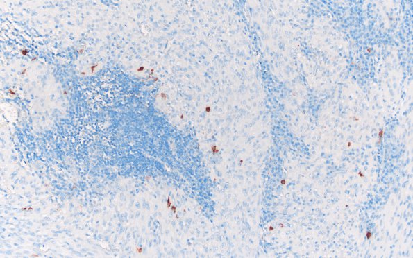 8E TTF1 TTF1 Granular Cell Tumor (Case 8) S100 most 20X