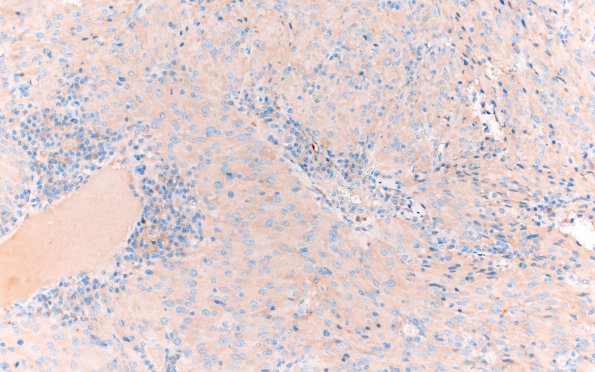 8F TTF1 Granular Cell Tumor (Case 8) SYN 20X