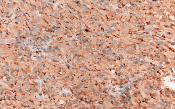 8G1 TTF1 Granular Cell Tumor (Case 8) CD68 40X 2