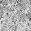 8K2 TTF1 Granular Cell Tumor (Case 8) EM 003 (2) - Copy