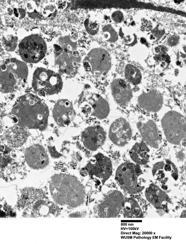 8K5 TTF1 Granular Cell Tumor (Case 8) EM 018 - Copy