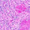 8M1 TTF1 Granular Cell Tumor (Case 8) PAS 40X