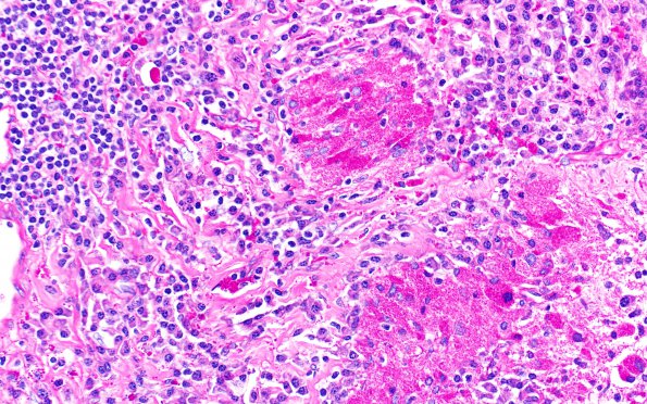 8M1 TTF1 Granular Cell Tumor (Case 8) PAS 40X