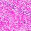 8M3 TTF1 Granular Cell Tumor (Case 8) PAS 60X 2