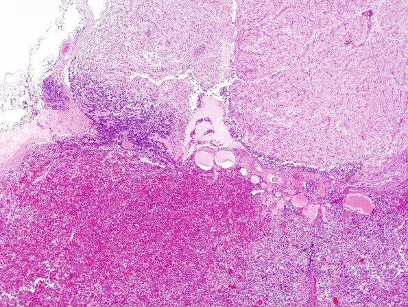 11A5 PA basophil inv (Case 11) H&E 4