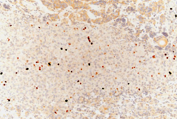 13E2 Pituitary adenoma, ACTH  (CR, Case 13) Ki67 20X