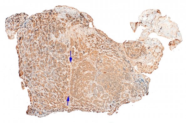 16C1 PA, CR (Case 16) ACTH 4X