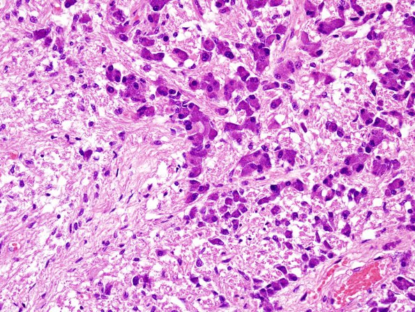 19A3 Pituitary adenoma (Case 19) H&E 1.jpg