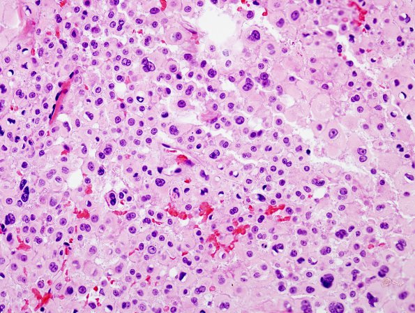 1A1 Pituitary adenoma (Case 1) H&E 6