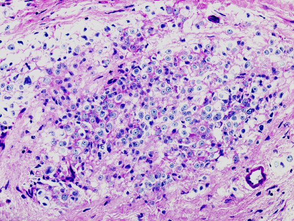 1D Pituitary adenoma (Case 1) PAS1